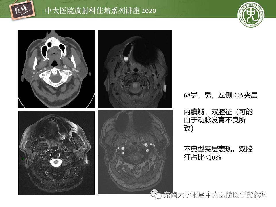 颈动脉夹层的超声表现及漏诊分析,动脉夹层与夹层动脉瘤是一样的吗
