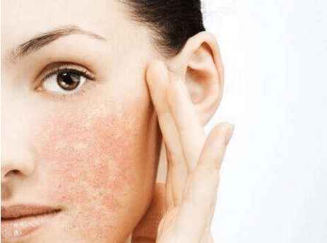 脸上过敏发红肿发痒怎么办最有效,脸上过敏发红肿怎样才能消除