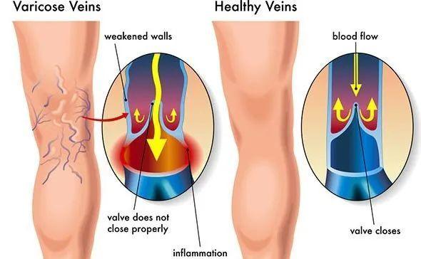 静脉曲张的危害什么是静脉曲张,预防静脉曲张穿多久静脉曲张袜