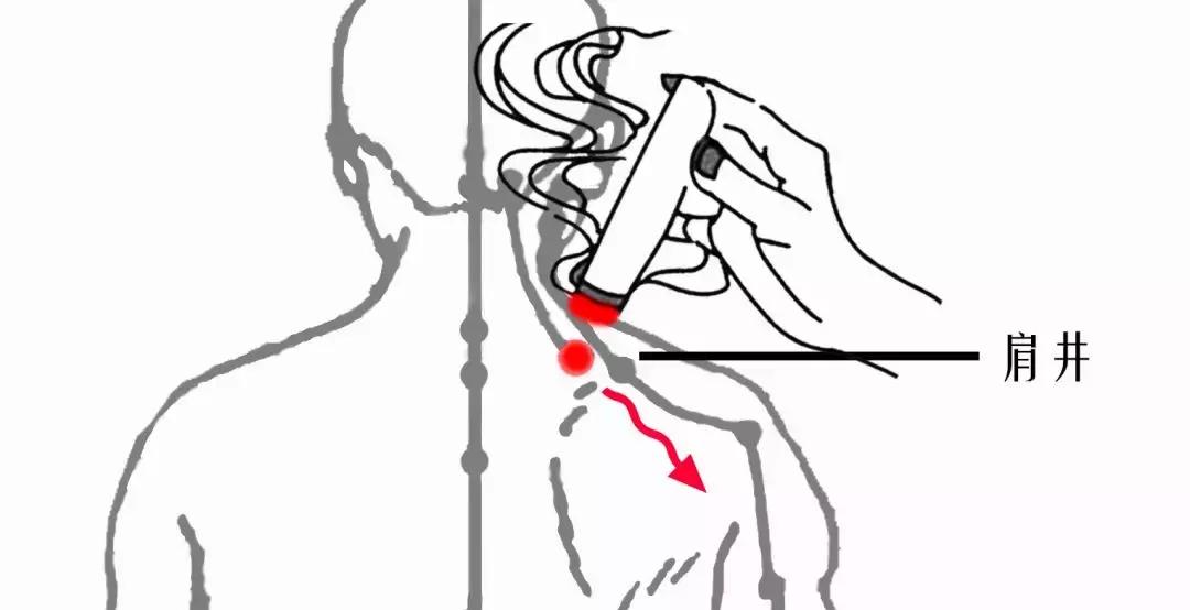 颈椎腰腿痛针刀,针刀颈椎病