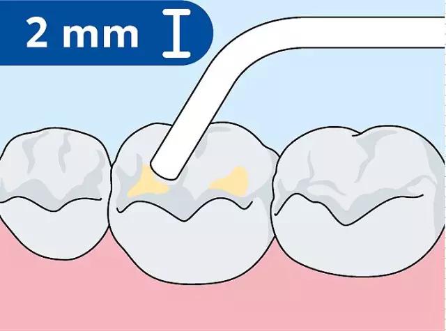 什么是儿童窝沟封闭？会不会痛？1分钟视频带你看懂#雅悦齿科#