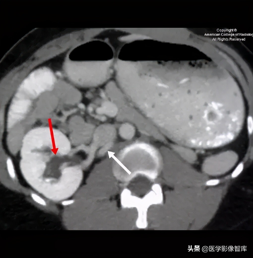 先天性无阴道综合征的影像诊断