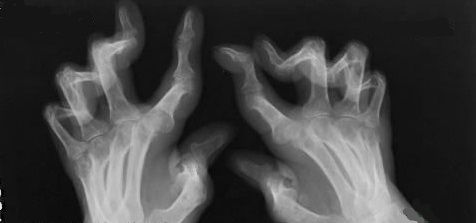 类风湿造成的关节变形可恢复吗?大多不行,有两种情况可以