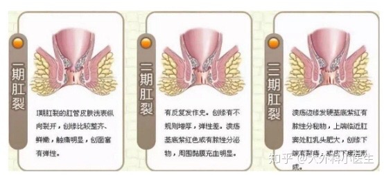 急性肛裂是怎么回事,肛裂出血会导致重度贫血吗