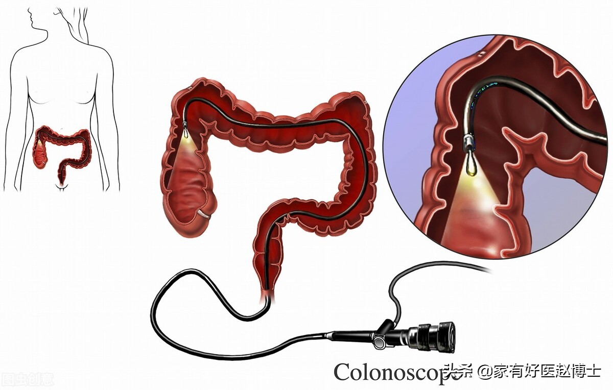 最常见5类息肉每个人都可能有，哪些无癌变风险，哪些需要切除？