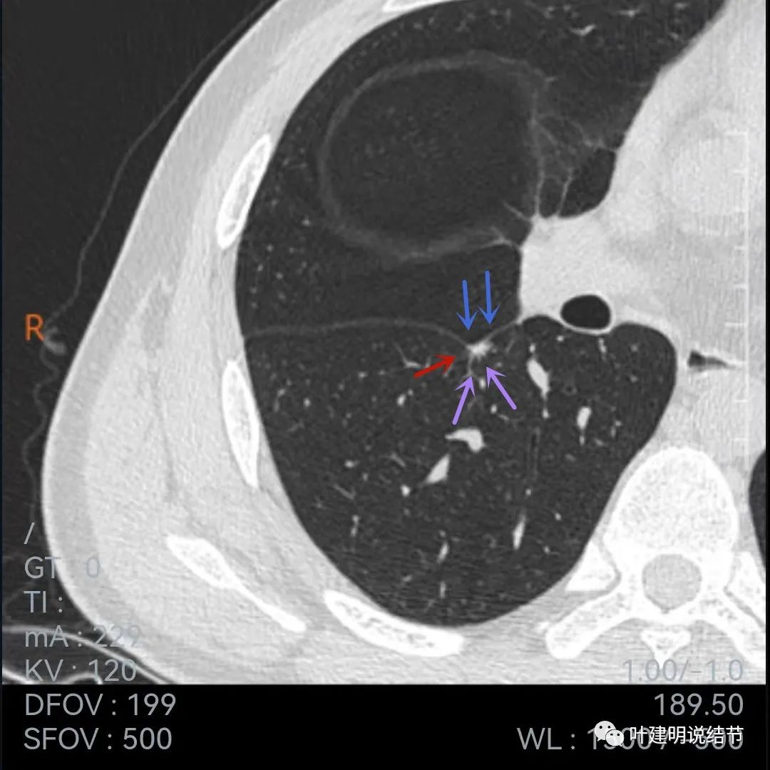 问诊分析：存在了4年的实性结节会不会是肺癌？