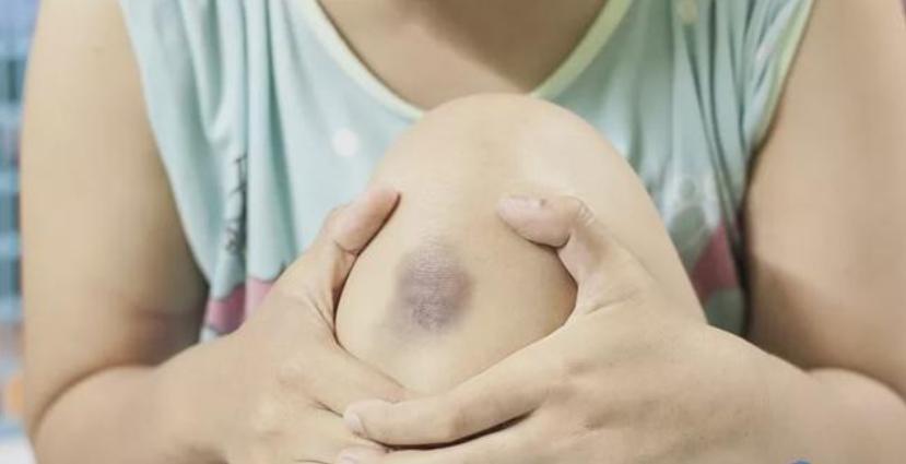 新生儿手臂上有淤青是什么原因,宝宝身上多了淤青什么引起的