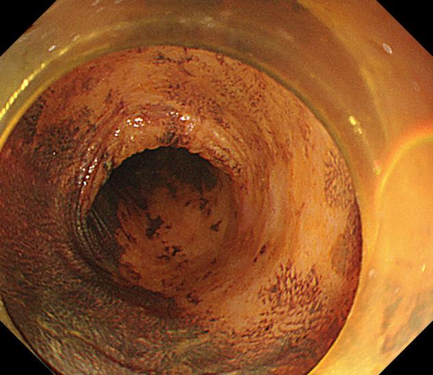 良性肿瘤也可用内镜下黏膜剥离术,内镜下粘膜剥离术后残留肿瘤