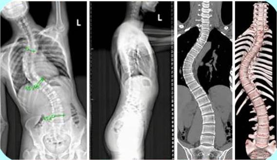 特发性青少年脊柱侧弯病因不明吗,青少年特发性脊柱侧弯怎么办
