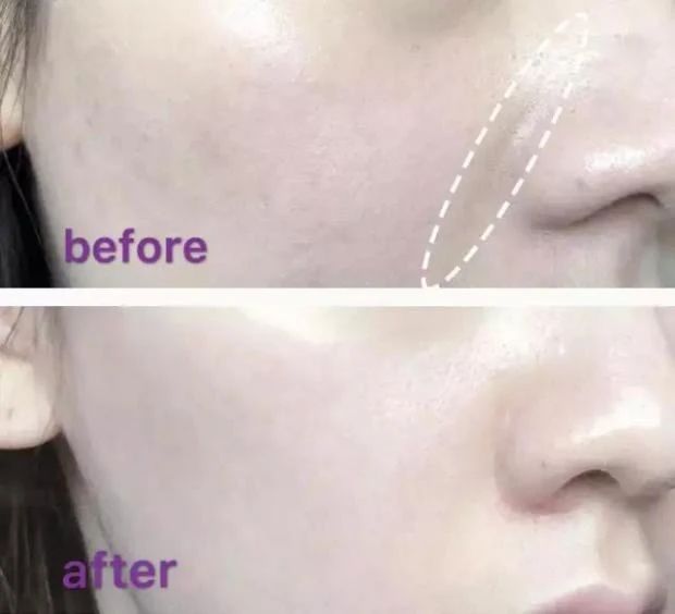 杨紫近照曝光无修图法令纹很深,杨紫面部填充法令纹