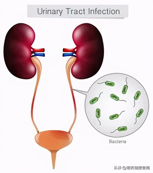 尿路感染最新指南5大要点轻松学,尿路感染先别用药给你三个建议