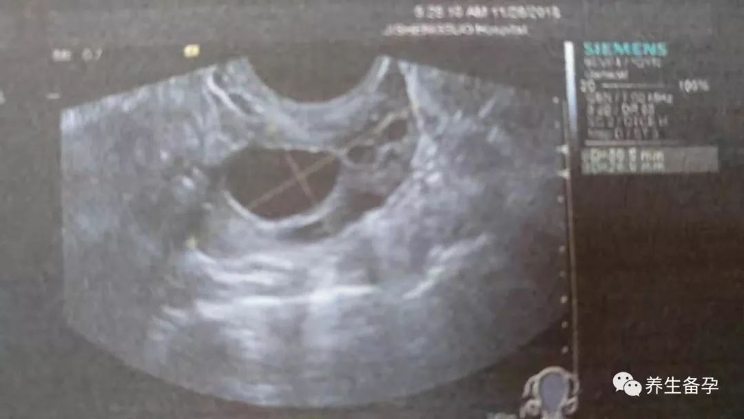 查卵泡发育做什么检查,b超监测卵泡发育不良但是怀孕了