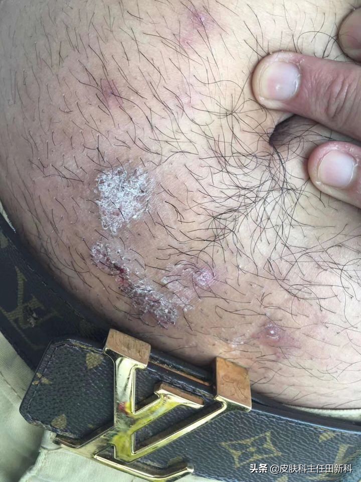 真菌感染性皮肤病原因,人真菌皮肤病怎么治