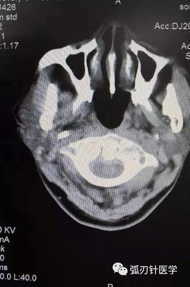 环枢椎错位,张口位X片显示环齿间隙左宽右窄,处理哪一侧?