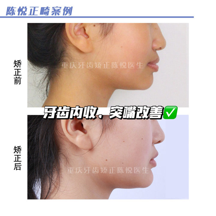 嘴凸深覆合可以自己矫正吗,上海牙齿龅牙矫正