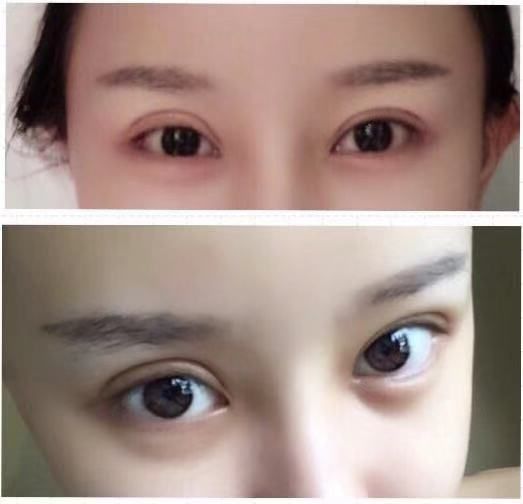 戚薇双眼皮修复视频完整版,戚薇肉条双眼皮是如何恢复的