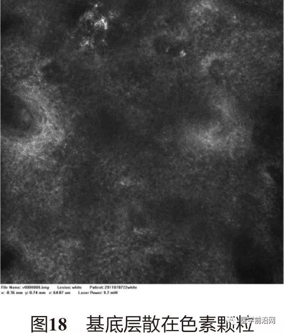 皮肤共聚焦显微镜能查什么,皮肤镜和共聚焦显微镜