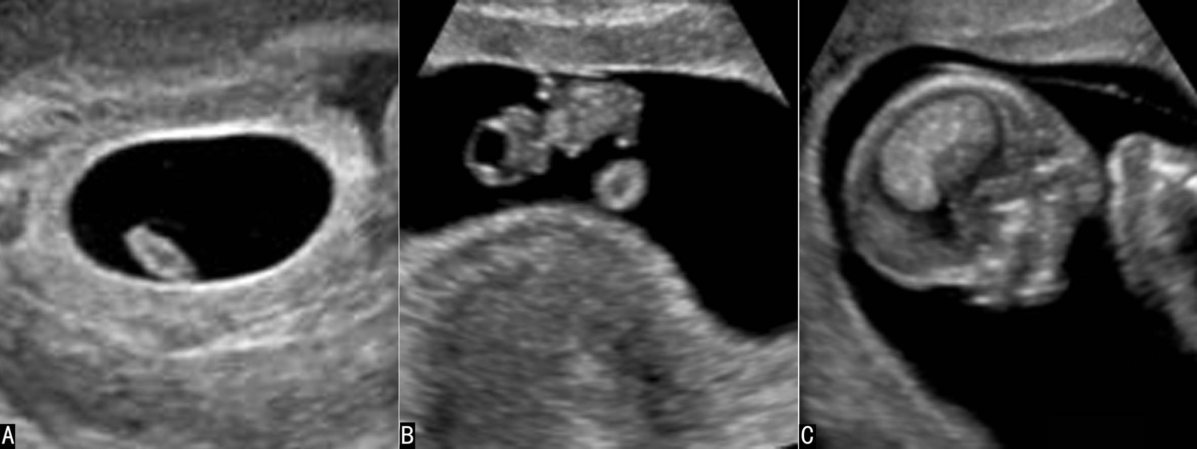 明明白白做超声（十九）：羊水和胎膜超声检查