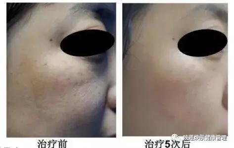 脸部皮肤严重缺水怎么调理,皮肤油光暗沉怎么办