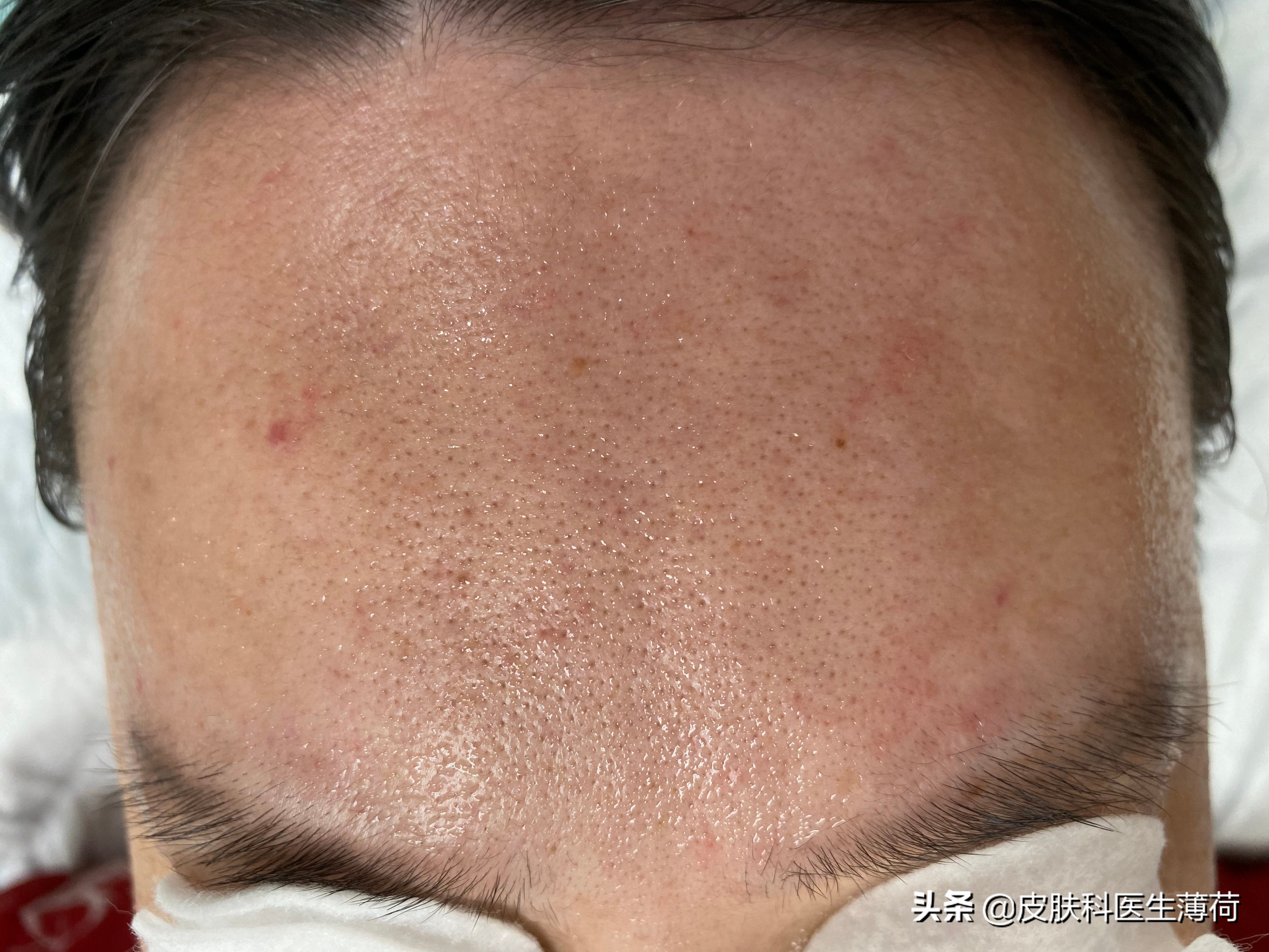 医生建议收缩毛孔的最好方法,医生清理毛孔