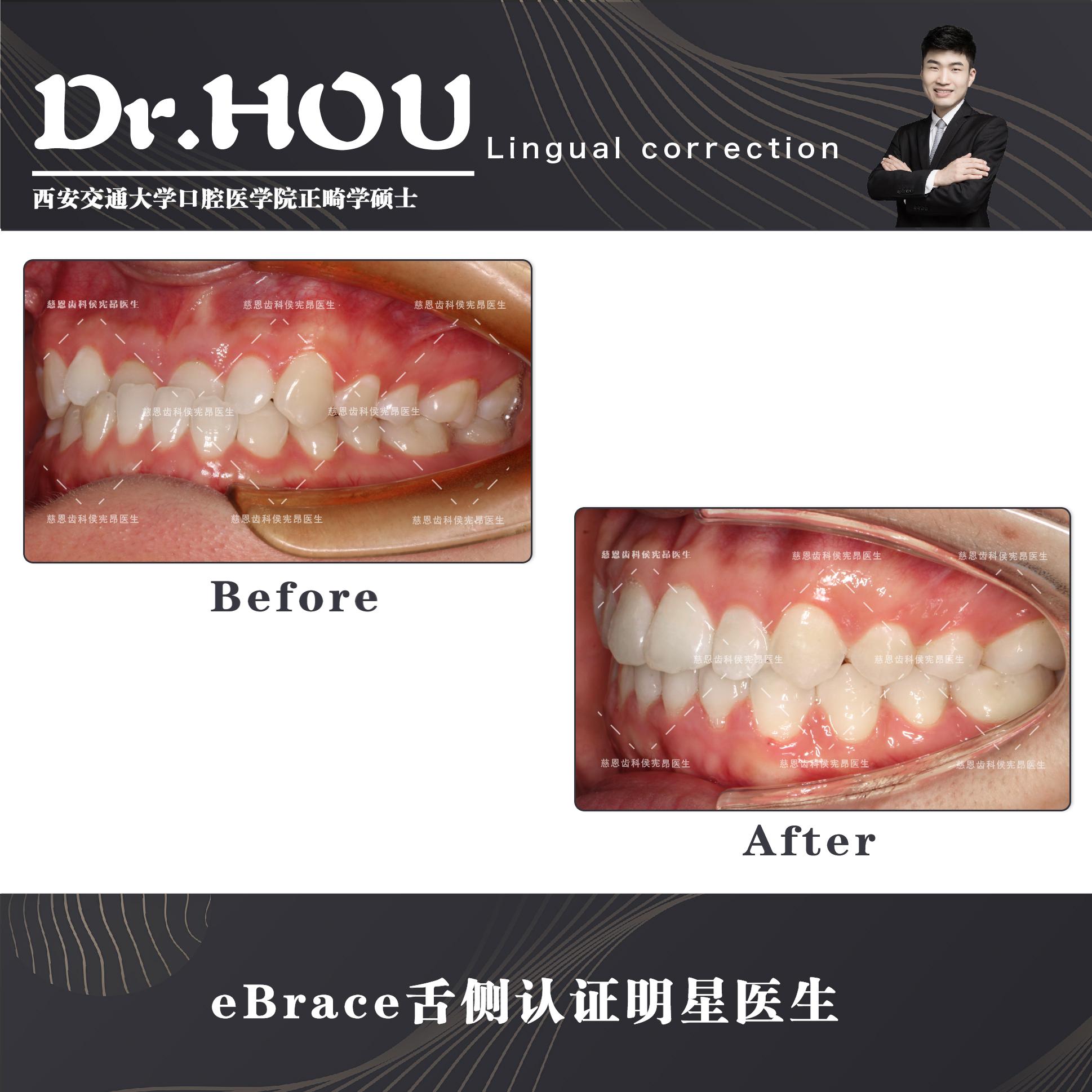 地包天的牙齿图片,牙齿地包天怎么补救