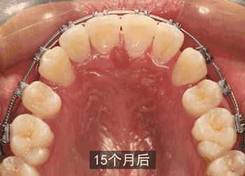 烤瓷牙金属露出来了有毒吗,烤瓷牙内部金属有毒吗