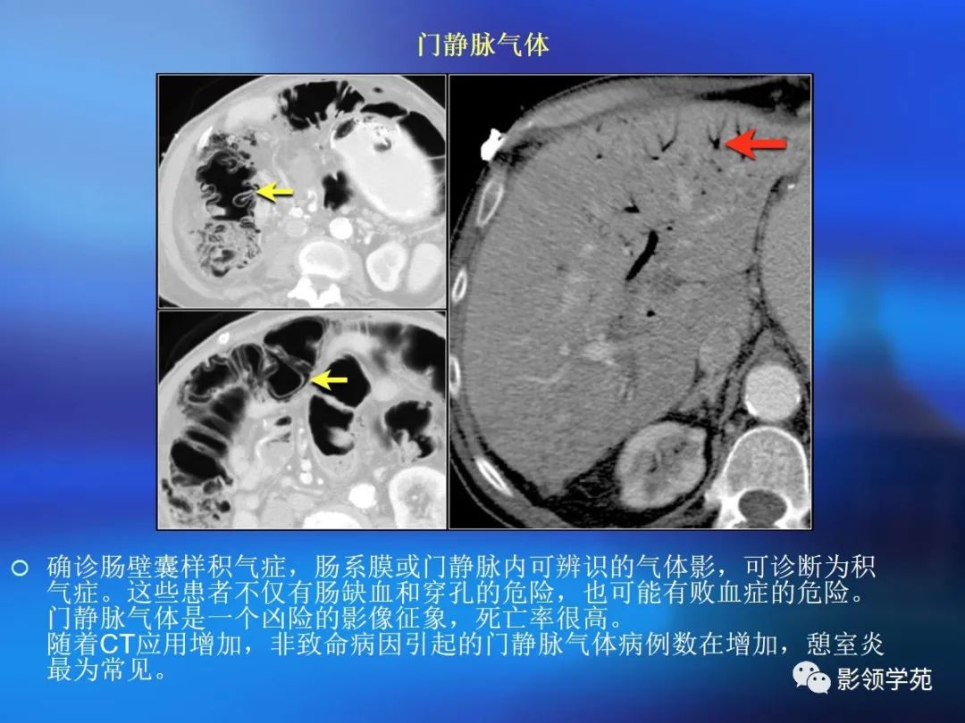 肠道内壁增厚,肠道扩张ct表现