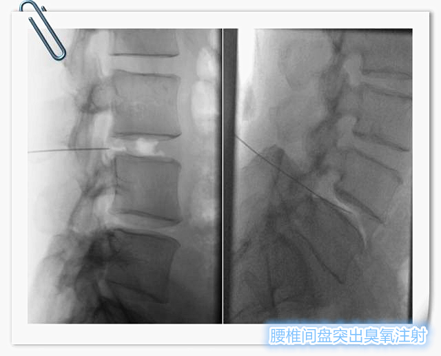 腰椎间盘突出打臭氧针属于微创吗,腰椎间盘突出臭氧还是射频效果好