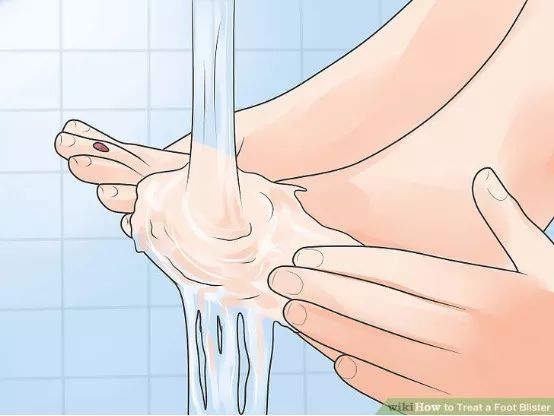 怎么预防跑步起水泡,一到夏天跑步脚就起泡怎么办