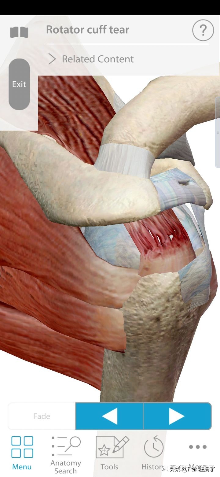 肩关节挫伤脖子痛,肩部肌肉扭挫伤怎么办