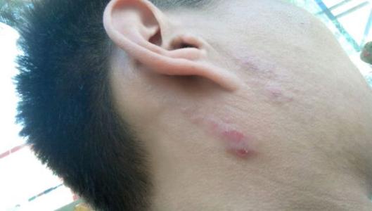 艾灸后神经性皮炎加重是怎么回事,得了神经性皮炎吃什么口服药