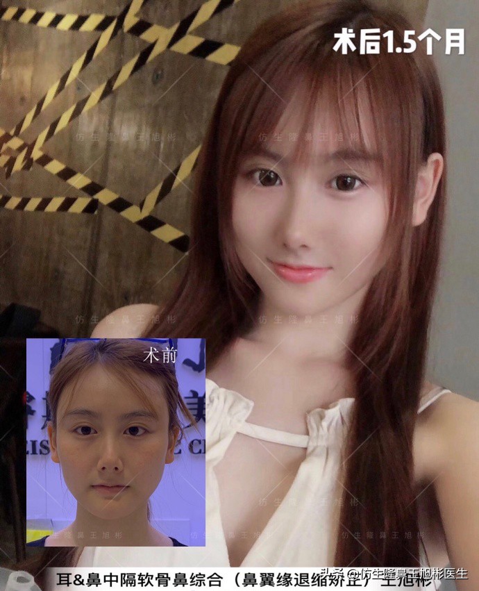 王旭彬:朝天鼻、露鼻孔,模特菲菲短鼻矫正手术后1.5个月