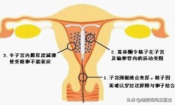 流产后直接上环要注意哪些事项,宝妈生完孩子上环