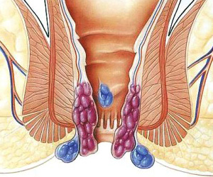俗话说十人九痔真是那么回事吗,痔疮到底是个啥为什么说十人九痔