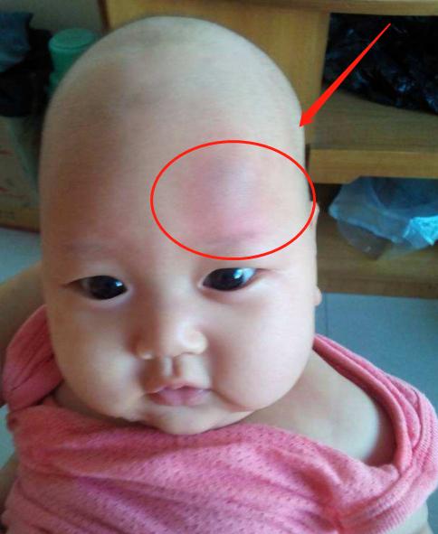 孩子摔伤头部的护理,孩子摔伤家长处理伤口