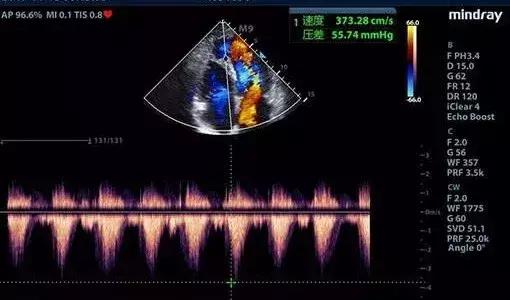 彩超怎么在屏幕上看是黑白的,为什么我的彩超是黑白色