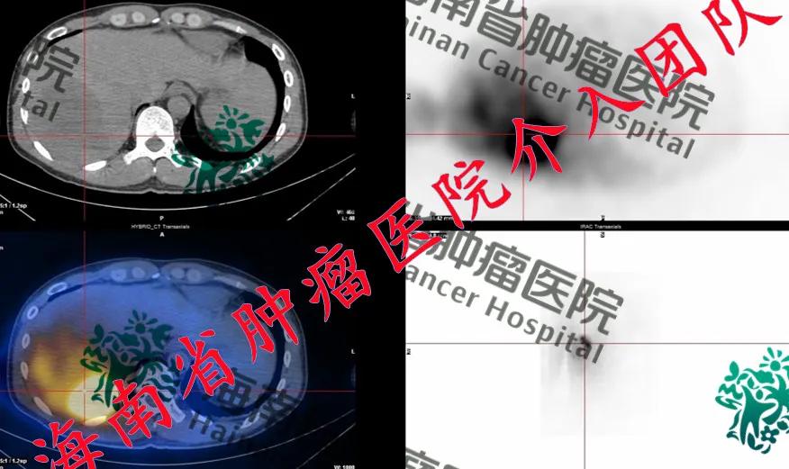 肝癌Y90树脂微球介入治疗技术临床应用落地海南