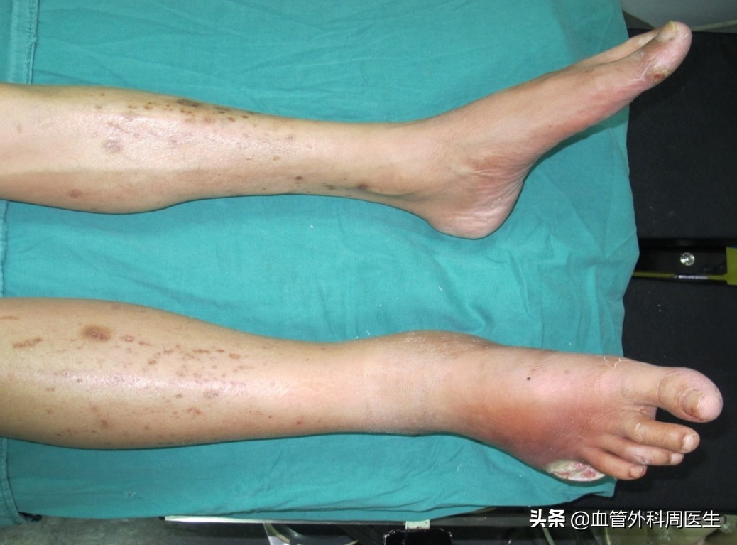 反复烂脚,老烂腿换药