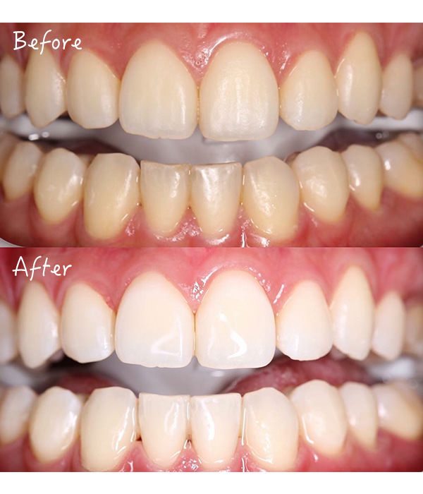 牙齿美白最好的技术,口腔牙齿美白