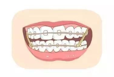 牙齿矫正完后不戴保持器会怎么样,牙齿矫正后不戴保持器会怎么样