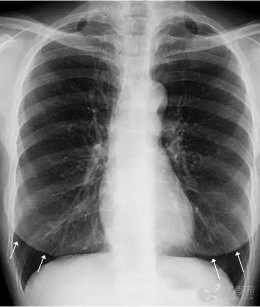 正常胸片图片,正常的胸片讲解