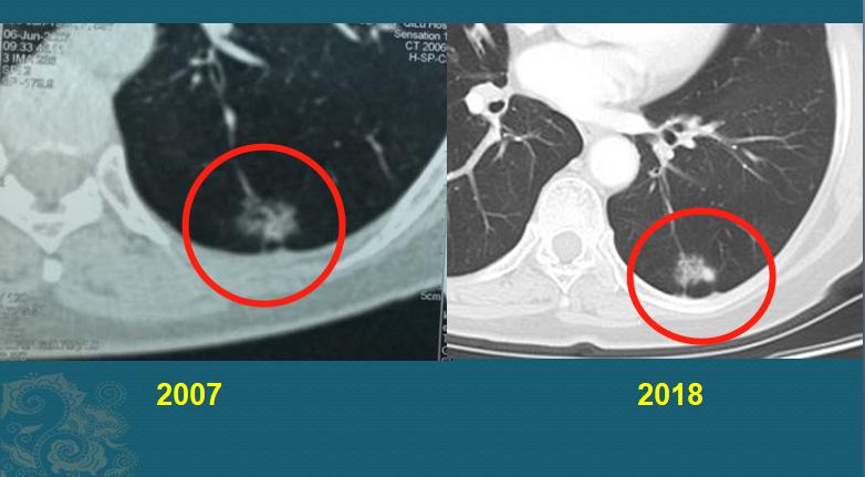 癌细胞增长的速度,癌细胞爆发性扩散
