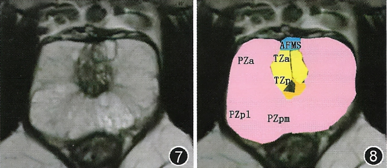 鍓嶅垪鑵簃ri褰卞儚瑙e墫,鍓嶅垪鑵簃ri瑙e墫