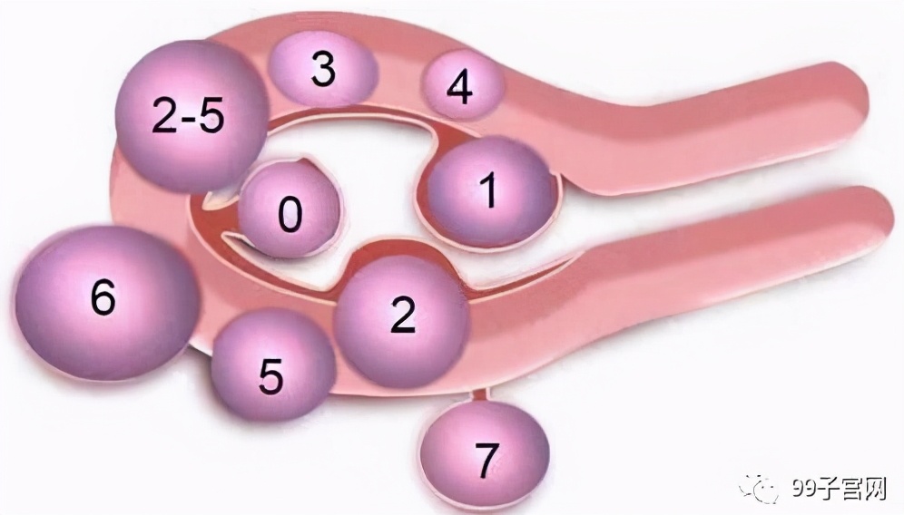宫腔镜子宫肌瘤剔除术后恢复,哪种子宫肌瘤需要手术