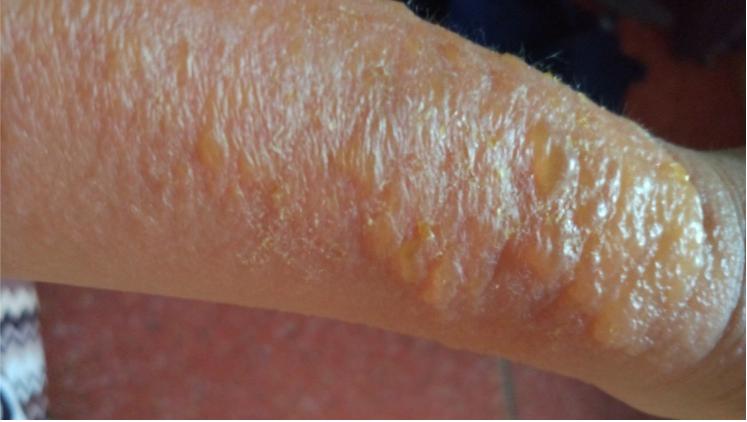 日光性皮炎用复方薄荷脑软膏,过敏性皮炎擦红霉素软膏