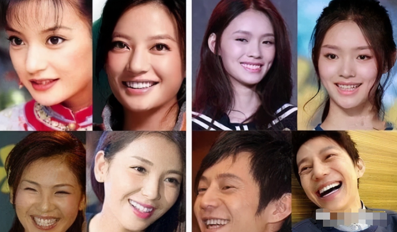 明星做了烤瓷牙翻车,烤瓷牙李佳琦