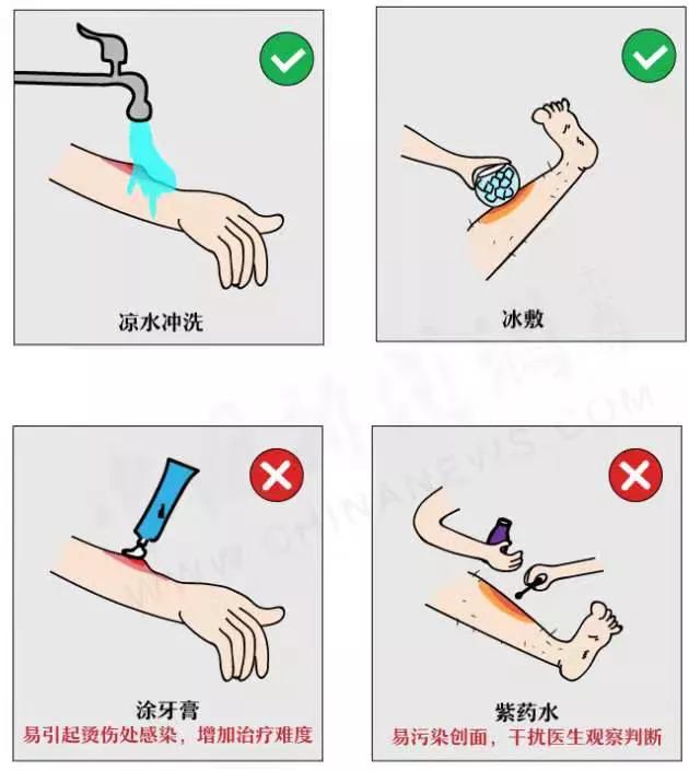 被暖宝宝烫伤是低温烫伤吗,暖宝宝低温烫伤红斑会起泡吗