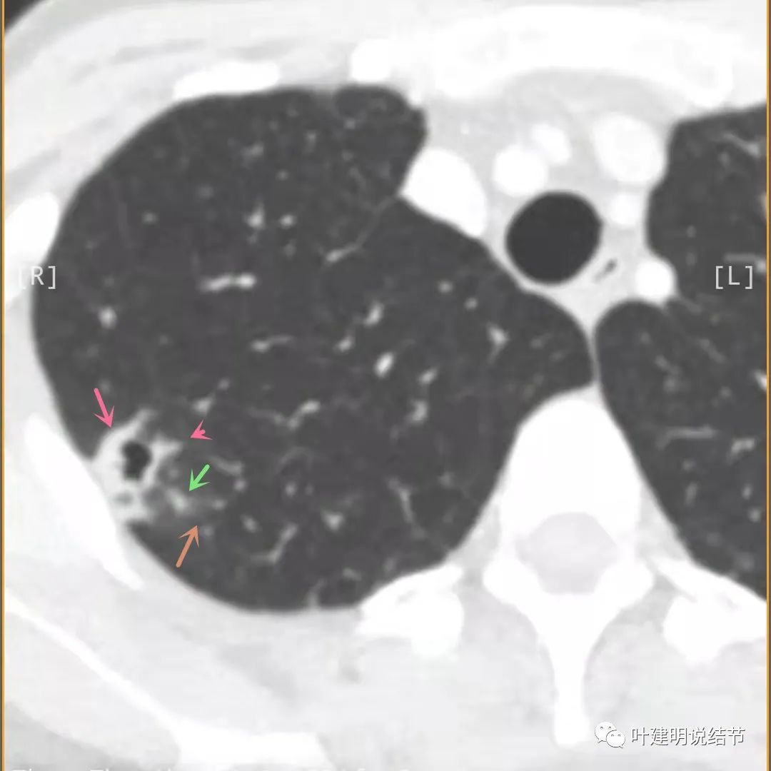 临床诊断孤立性肺结节,空洞型结节一般是什么性质