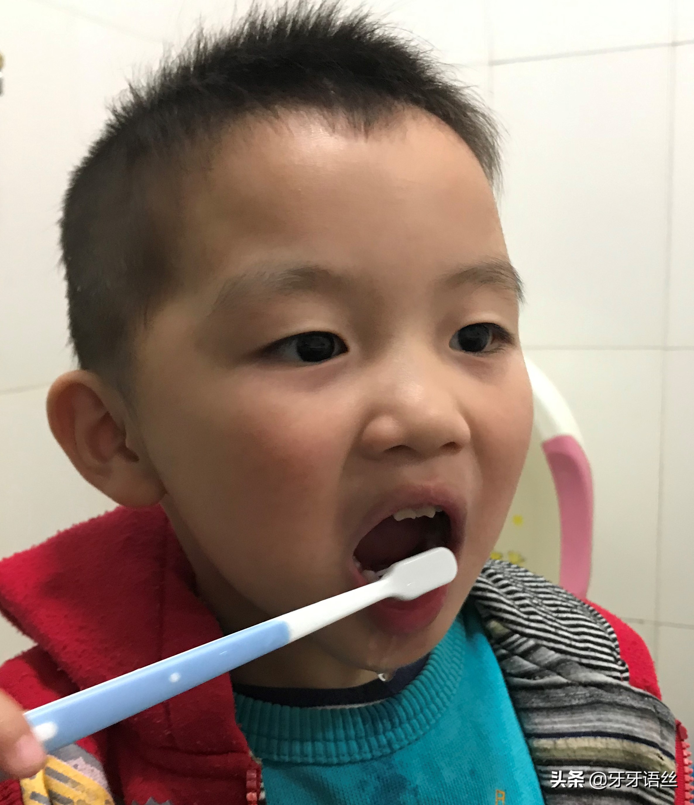 儿童龋齿的病因及预防诊治