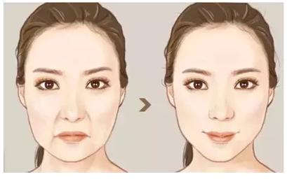 做一个拉皮手术人可以年轻多少岁,做拉皮的真实感受